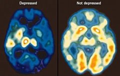 抑郁症只是心理变化，还是大脑发生了变化？